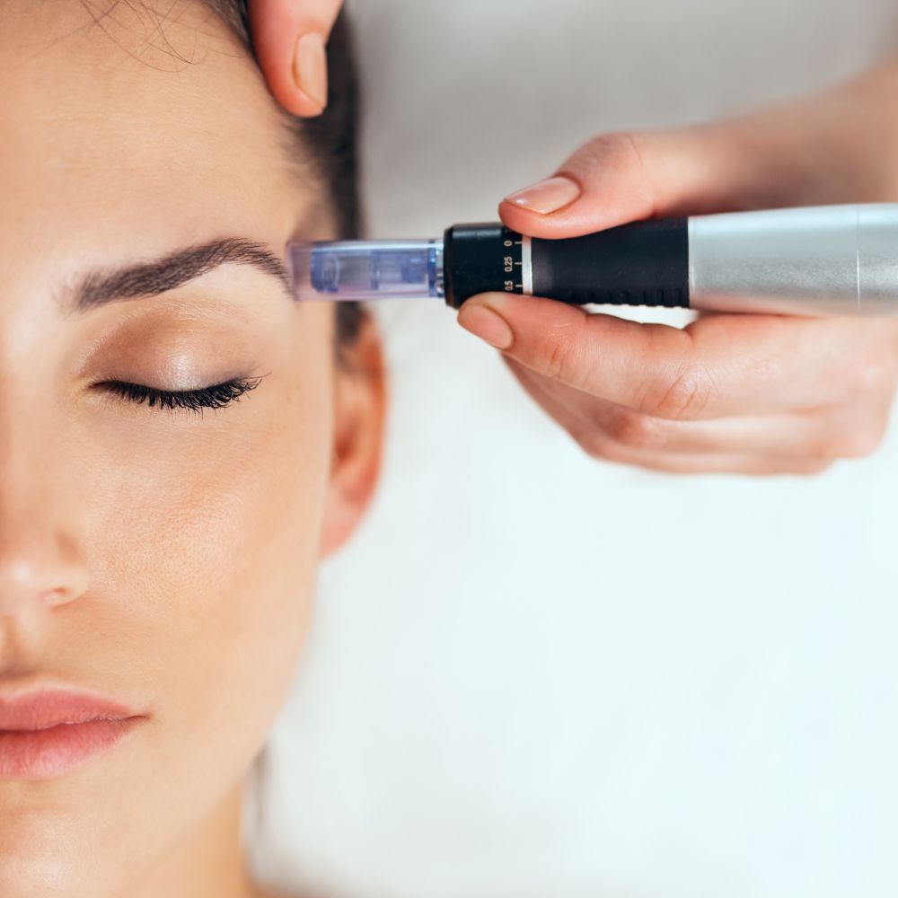 Tratamiento Global Dermplaning con Dermapen