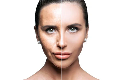 Tratamiento Dermapen (Microneedling Facial)